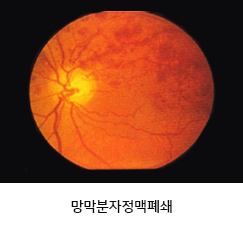 망막분자정맥폐쇄